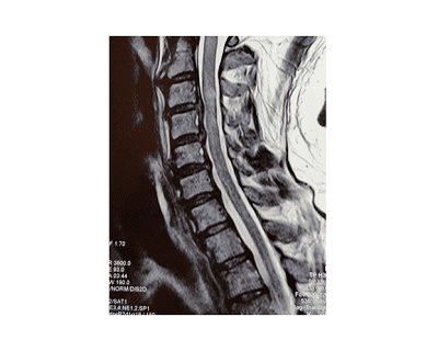 Hernia, Disco, discal, lumbar, toracica, torax, cervical