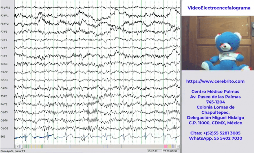 VideoEEG